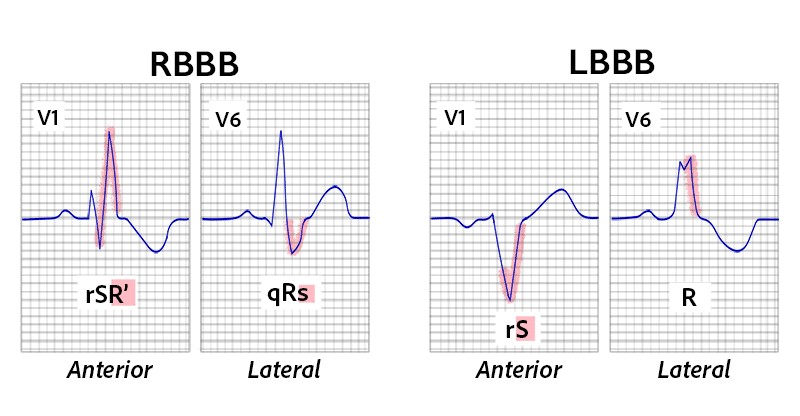 graphic showing bundle branch block deflections
