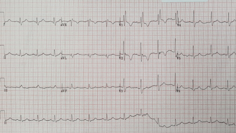 graphic of right bundle branch block