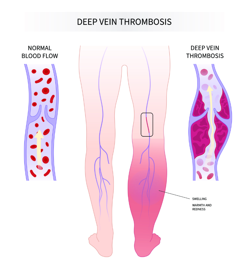 graphic showing deep vein thrombosis