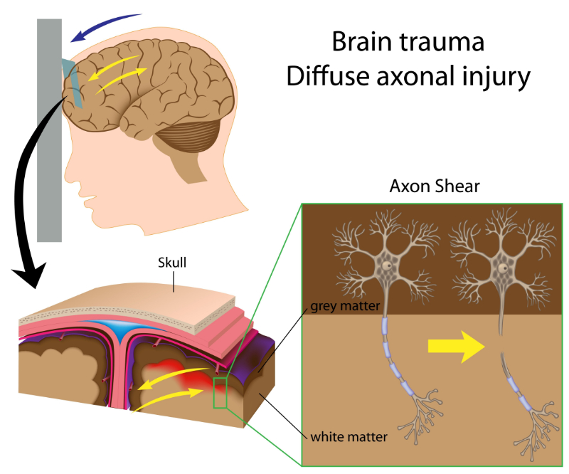 graphic showing diffuse axonal injury