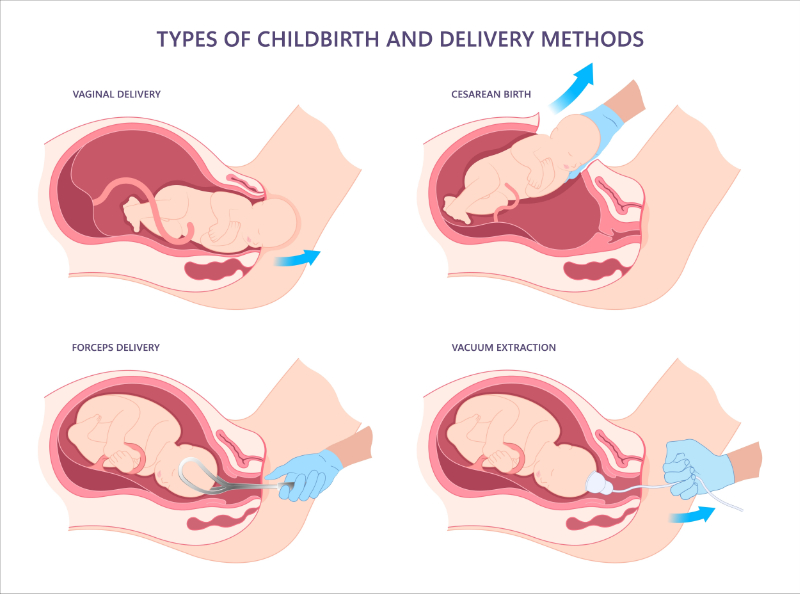 graphic showing types of childbirth and delivery methods