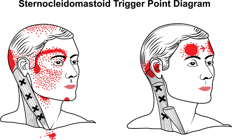 graphic showing referral pain pattern from trigger points