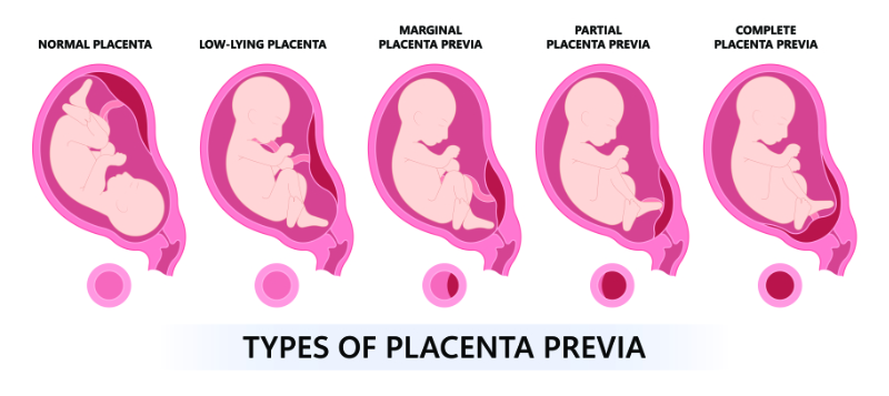 graphic showing five types of placental previa with fetus