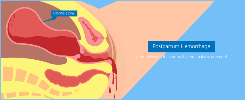 graphic showing uterine atony