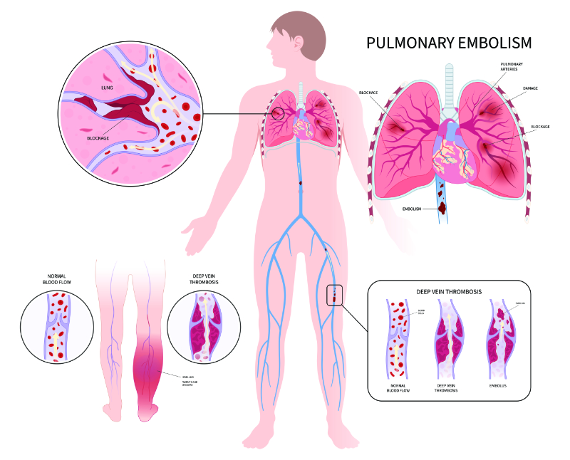 graphic showing venous thromboembolism