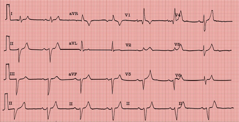 graphic showing bifascicular block