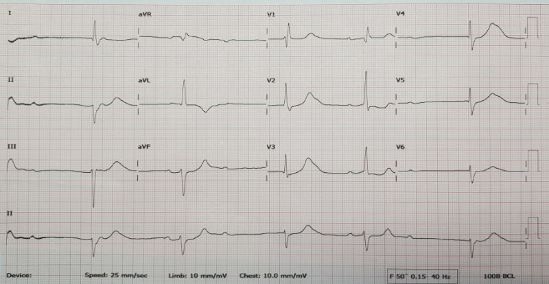 graphic of complete heart block