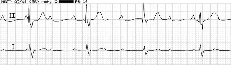 graphic of complete heart block