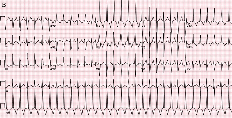 graphic showing junctional tachycardia