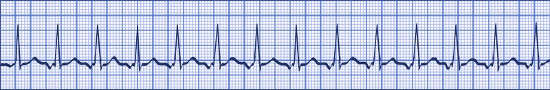 graphic showing junctional tachycardia