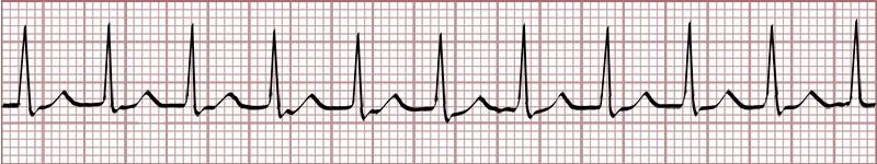 graphic showing av nodal reentry tachycardia