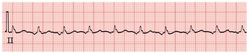 graphic showing atrial tachycardia