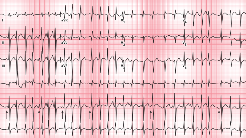 graphic showing multifocal atrial tachycardia