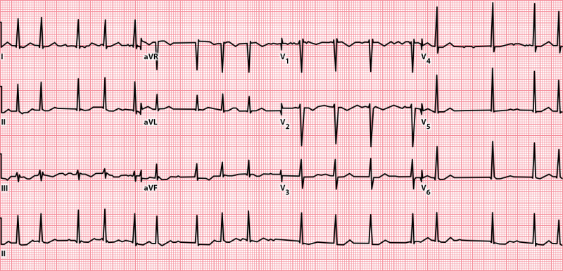 graphic showing atrial fibrillation