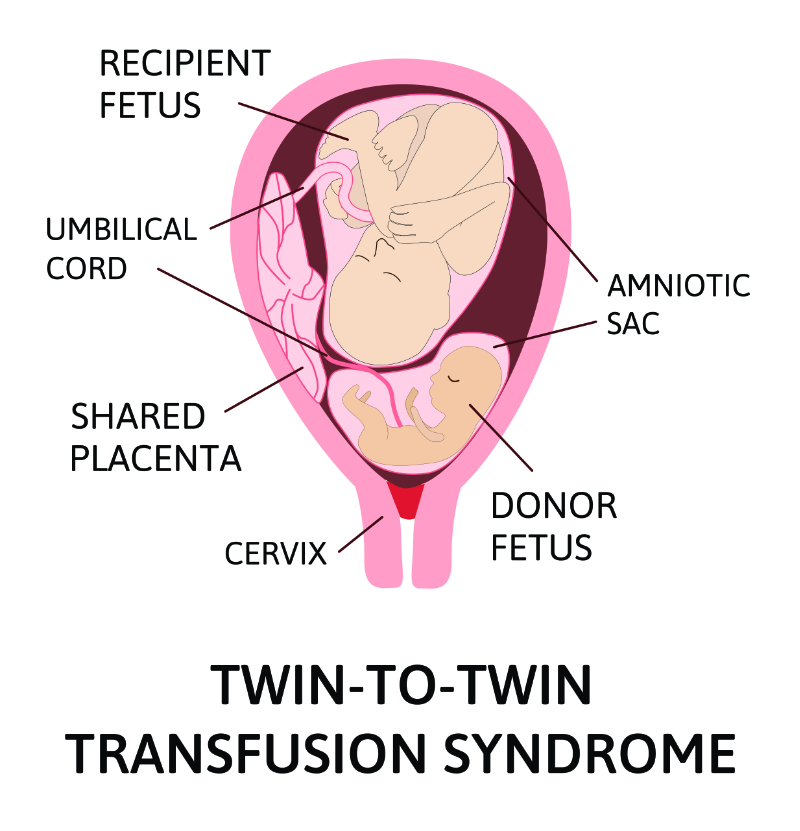 graphic showing twin to twin transfusion