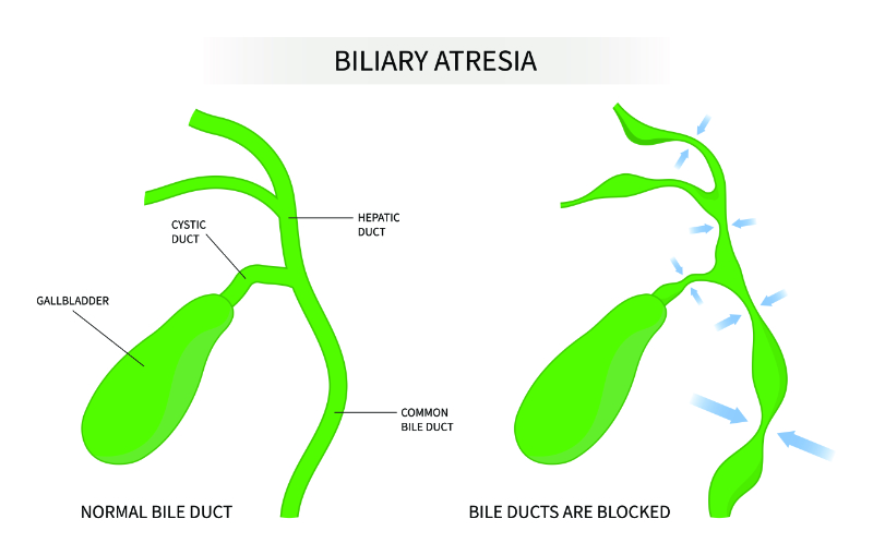 graphic showing labeled biliary atresia