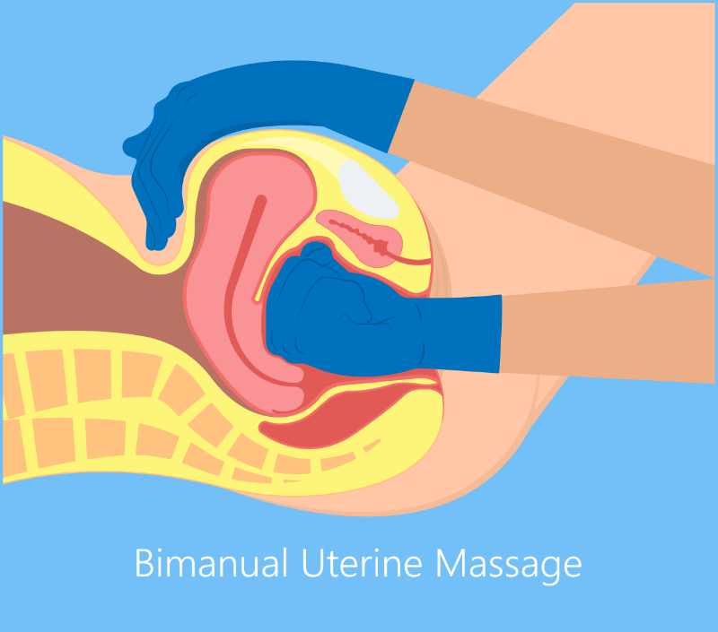 graphic showing bimanual uterine massage