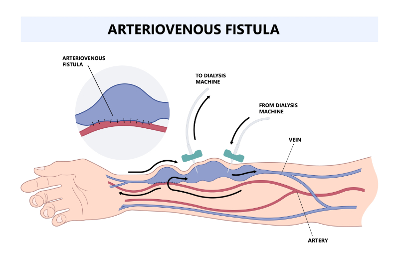 graphic showing fistula