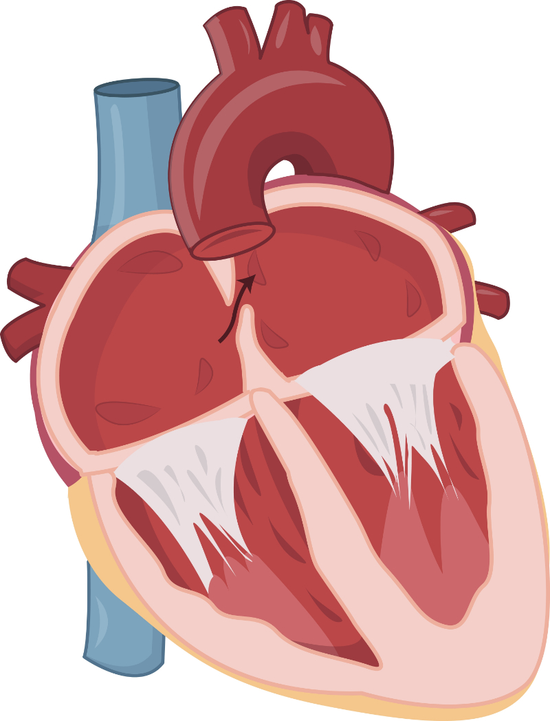 graphic showing patent foramen ovale