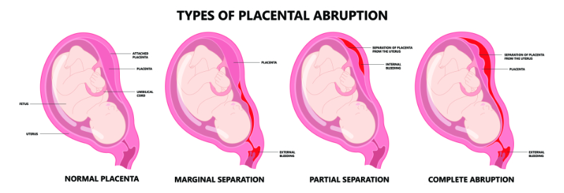 graphic showing four types of placental abruption with fetus