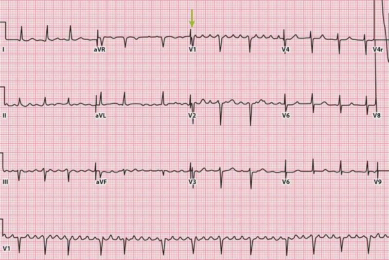 graphic showing atrial flutter