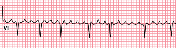 graphic of atrial flutter with variable conduction