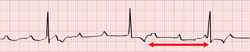 graphic showing third degree av block
