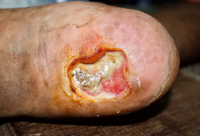 photo of diabetic foot ulcer