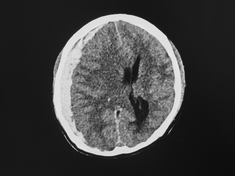 image showing subdural hematoma scan