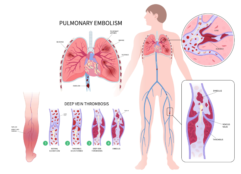 graphic showing pe vs dvt