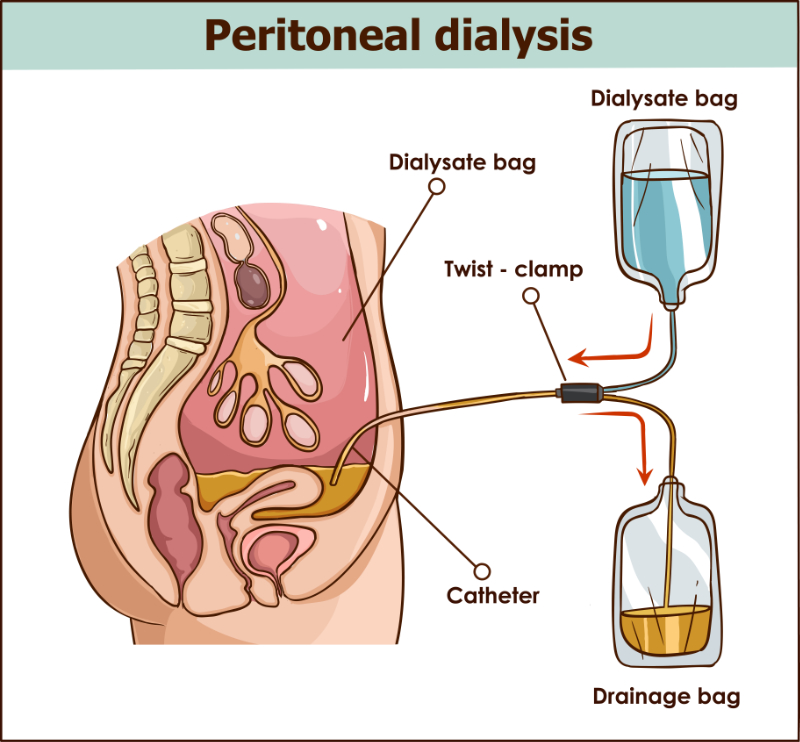 graphic showing peritineal dialysis