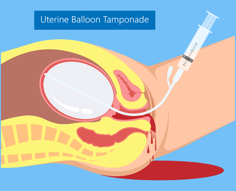 graphic showing uterine balloon tamponade