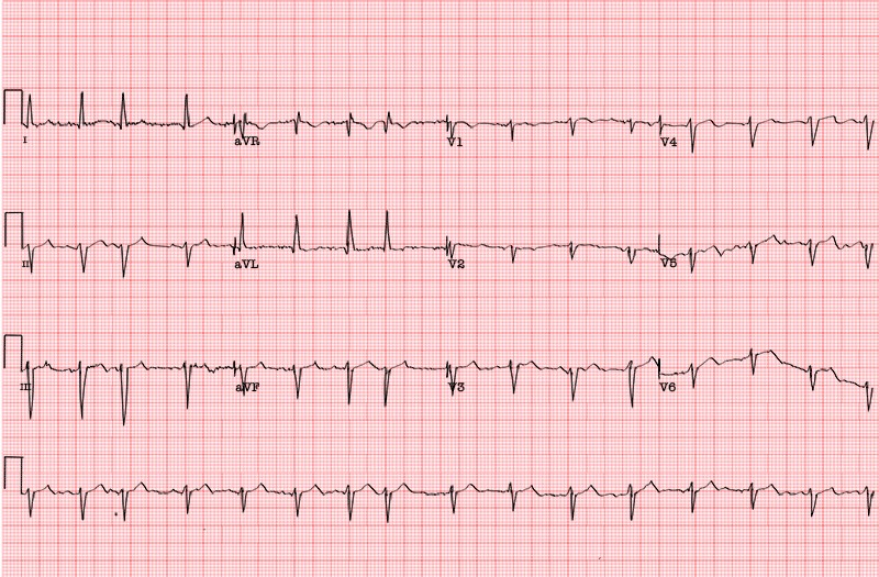graphic showing wandering atrial pacemaker