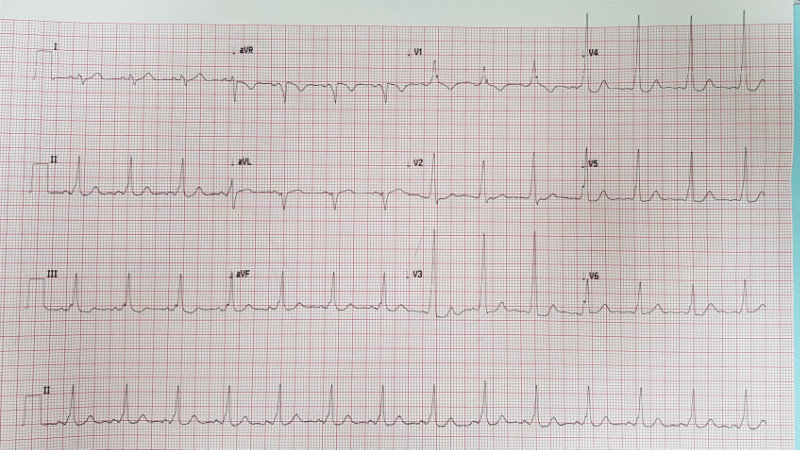 graphic showing wolff parkinson white syndrome