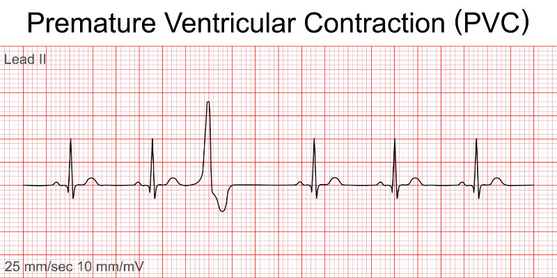 graphic showing premature ventricular contraction