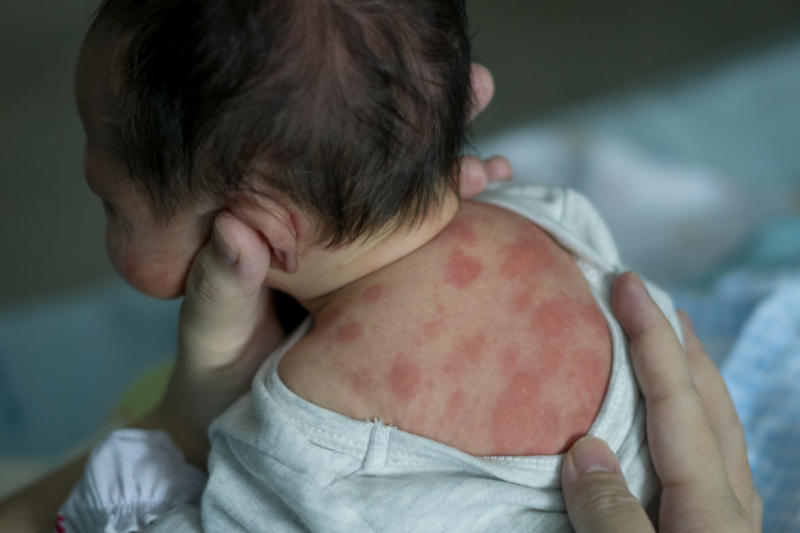 infant with erythema toxicum neonatorum