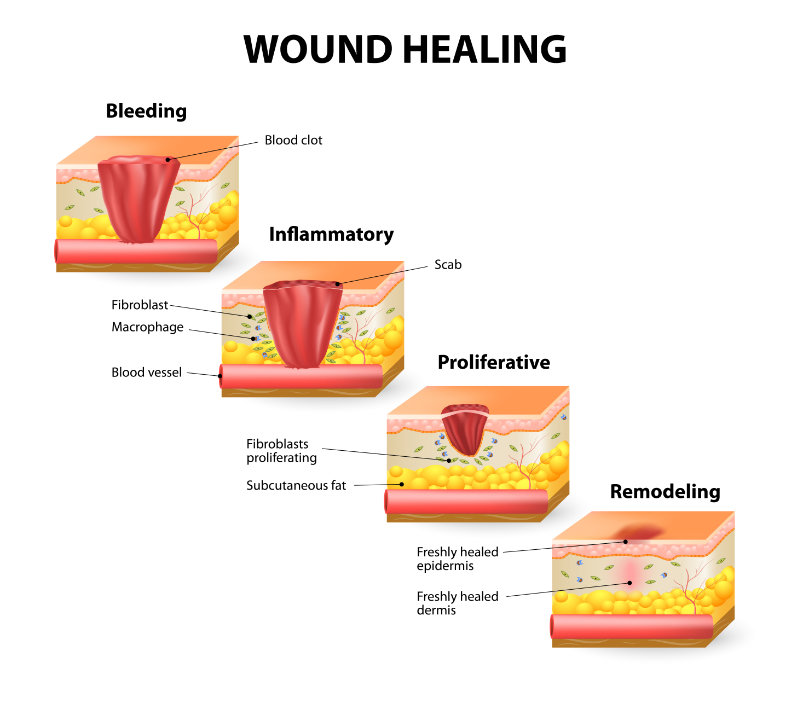 graphic showing phases of wound healing