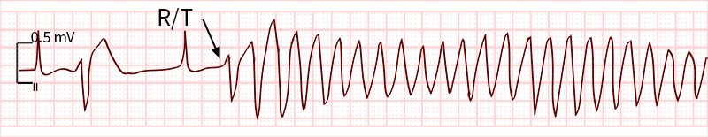 graphic showing r on t lead
