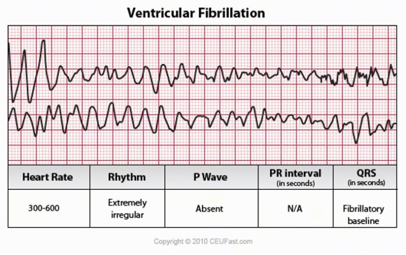 graphic showing ventricular fibrillation