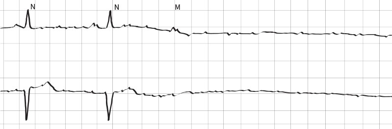graphic of fading to asystole