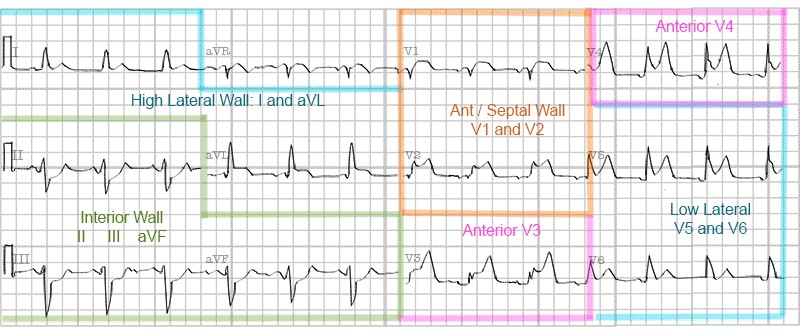 graphic showing stemi locations
