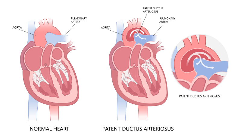 graphic showing normal vs pda