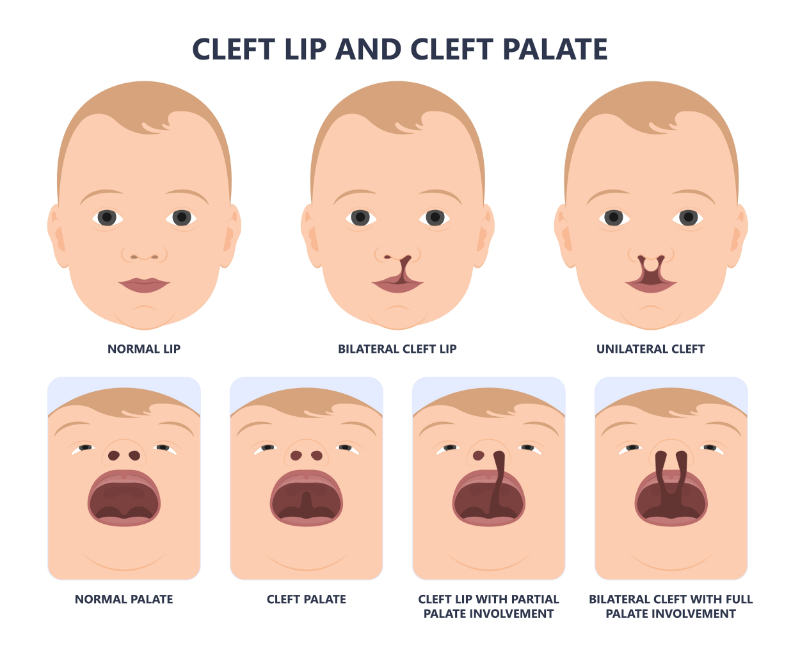 graphic showing types of cleft lip and cleft palate