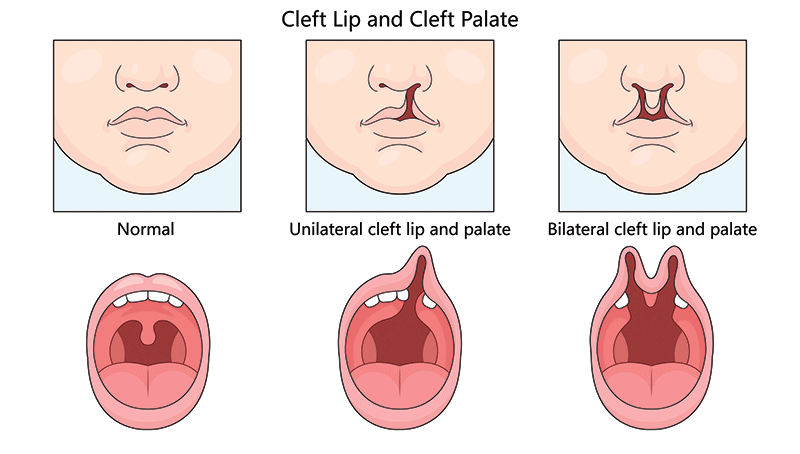 graphic showing types of cleft lip and cleft palate