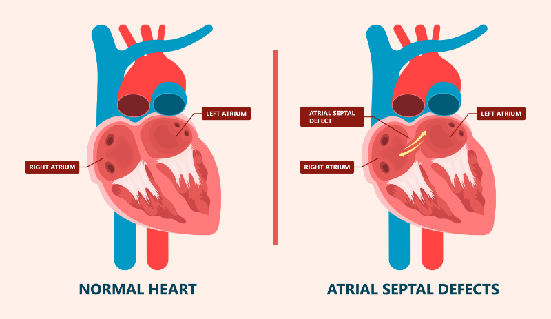 graphic showing atrial septal defect