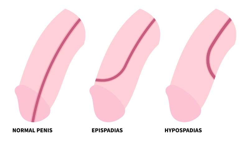 graphic showing hypospadias