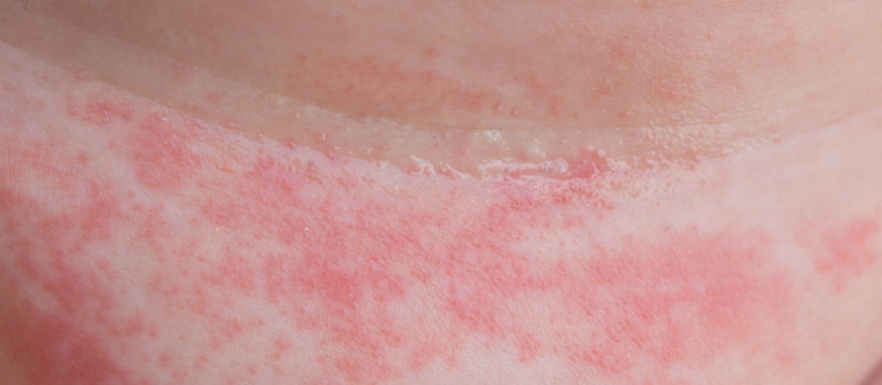 photo of diaper rash