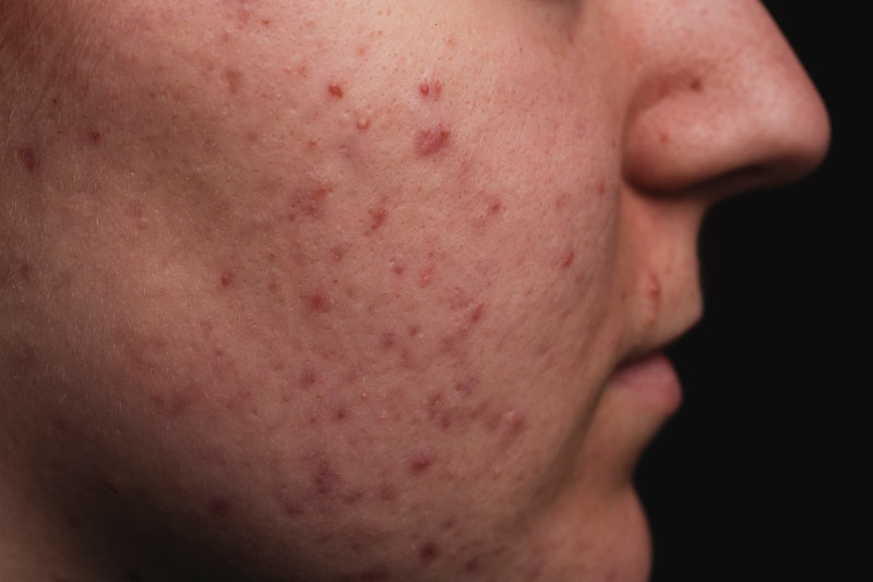 photo of acne vulgaris skin condition