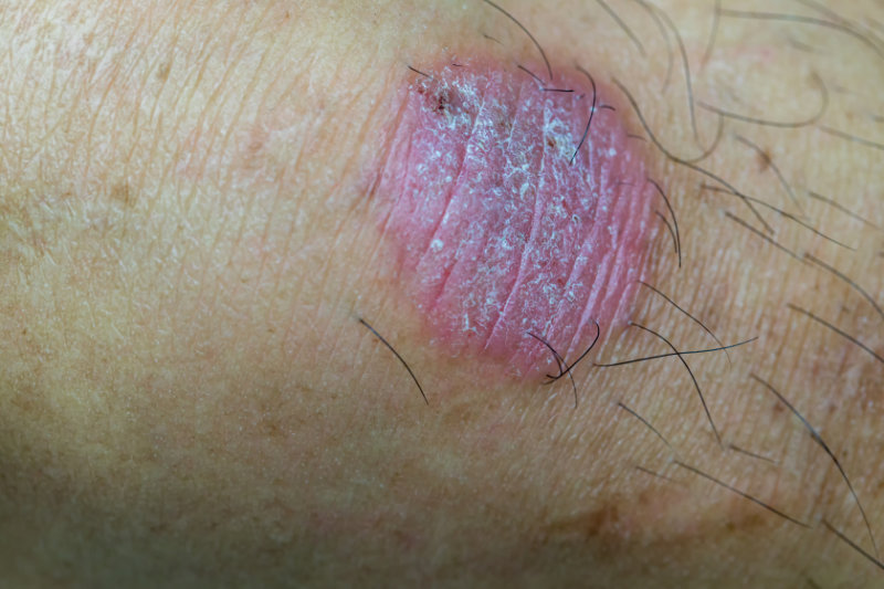 photo of tinea corporis