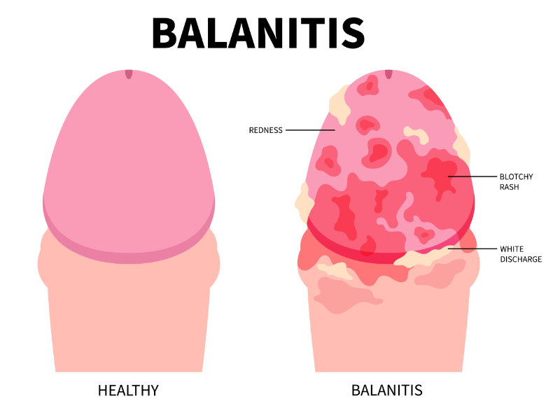 graphic showing balanitis